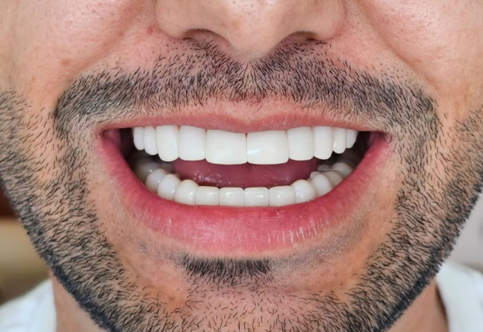 Resultado después de un tratamiento de ortodoncia